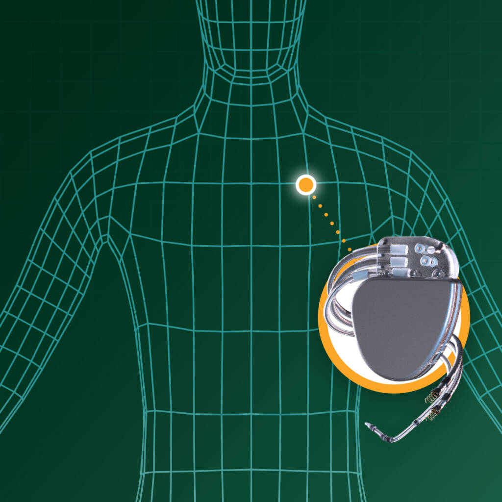 An implantable medical device made using Indium Corporation's AuLTRA MediPro.